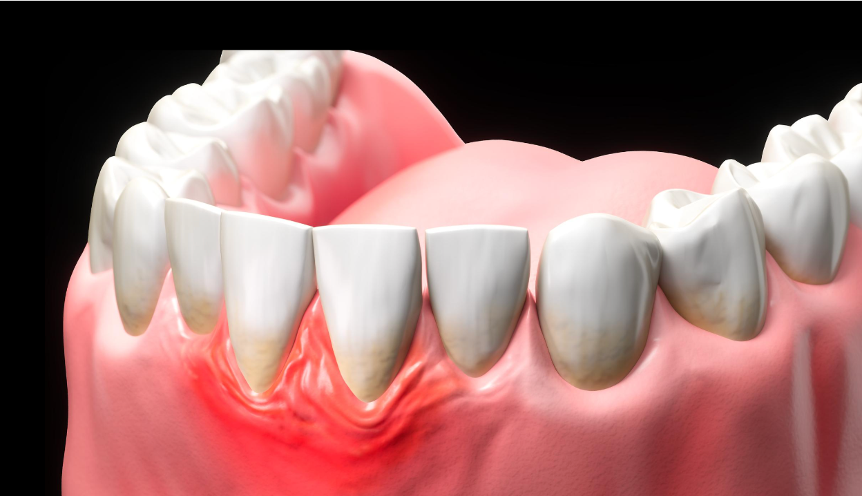 gingivitis
