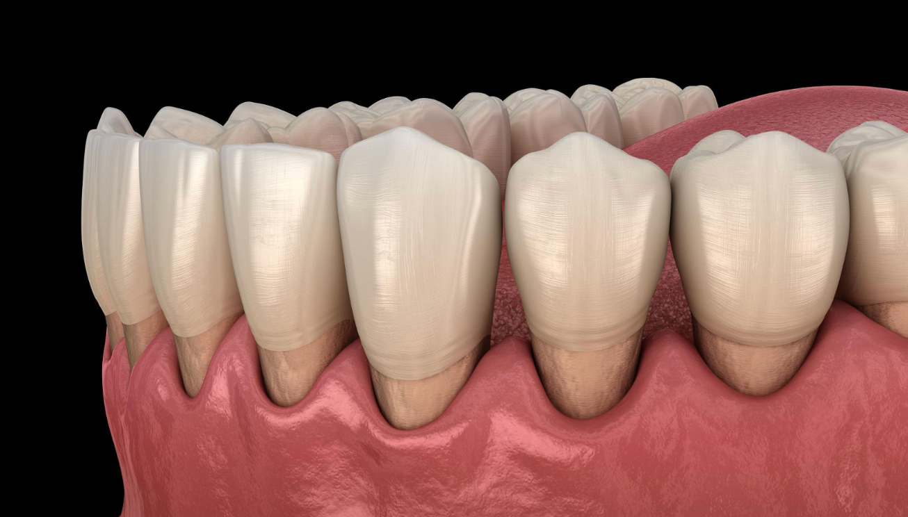 periodontitis