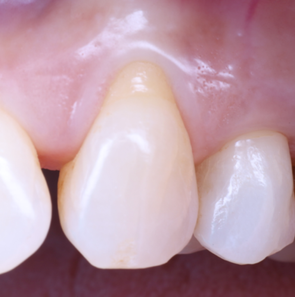 Cirugía mucogingival
