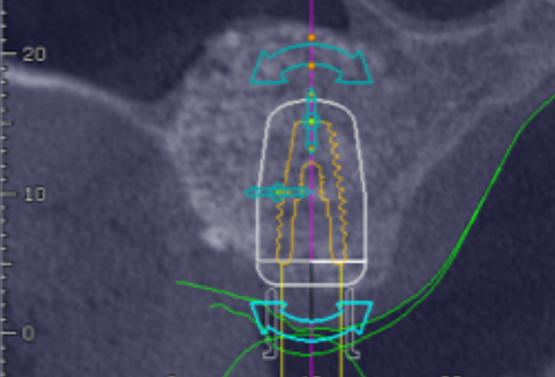 implantes dentales sin hueso