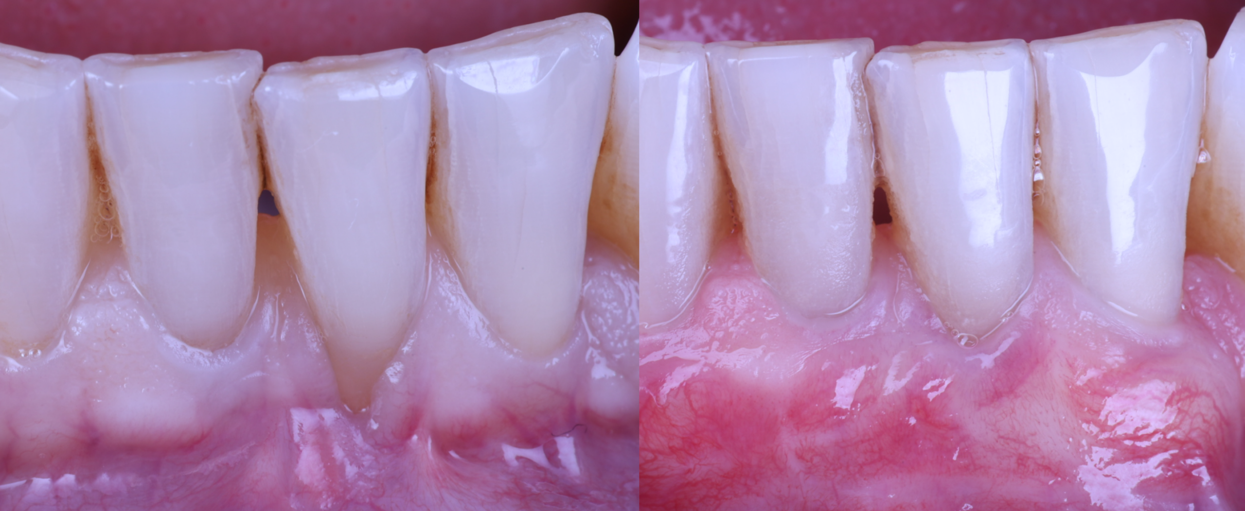 Cirugía mucogingival